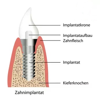 Abbildung Zahnimplantat